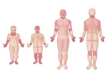 Pliegues de la dermatitis atópica