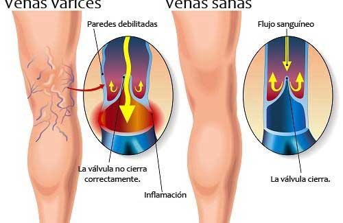 Formación de arañas basculares